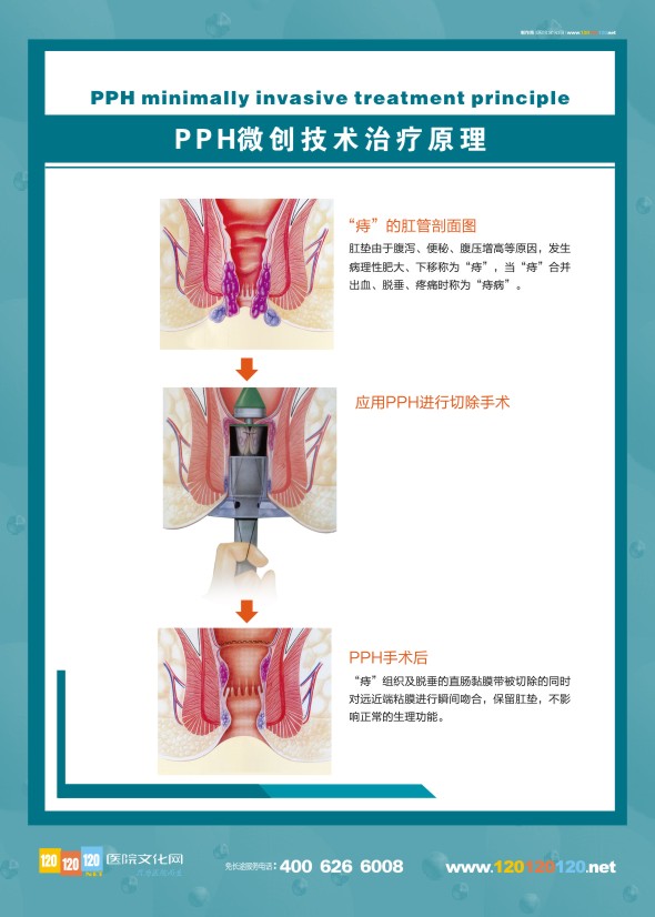 肛肠科解剖图-PHH微创技术治疗原理