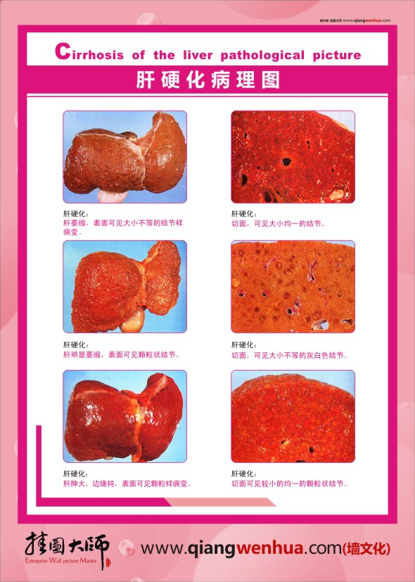 肝病健康教育 肝硬化病理图片